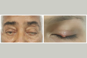 Ophthalmoplasty Services